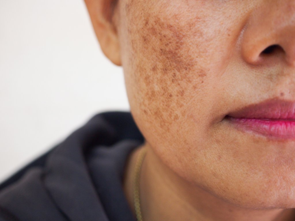 melasma and pigmentation removal in dubai